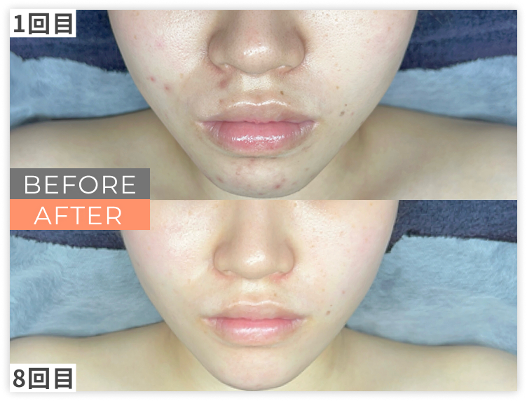 ララピール×LDMのビフォー/アフター